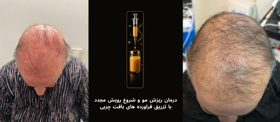 صفر تا صد تزریق چربی، SVF و نانو فت (دوره سوم)